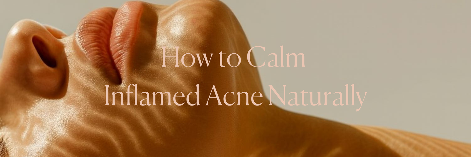 How to Calm Inflamed Acne Naturally