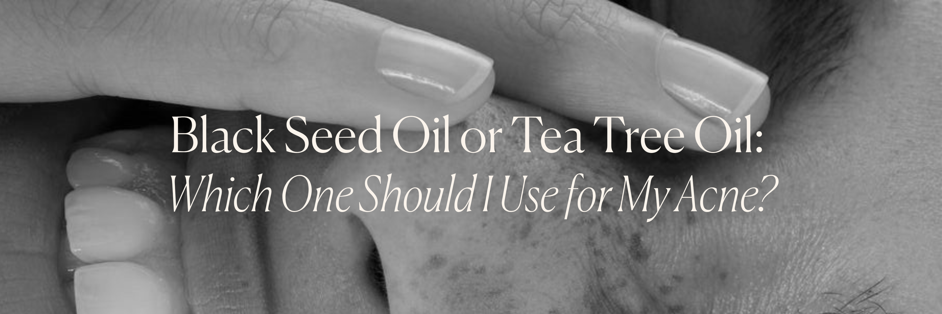 Black Seed Oil or Tea Tree Oil: Which One Should I Use for My Acne?