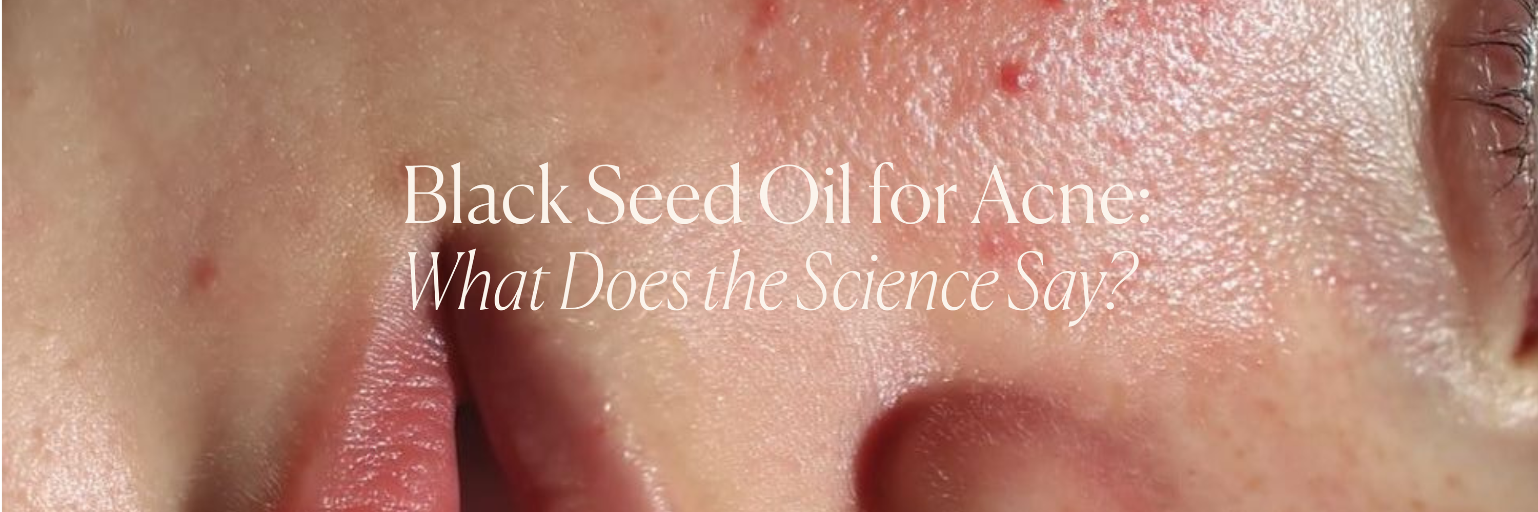 Black Seed Oil for Acne: What Does the Science Say?