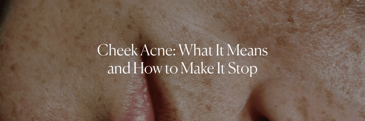 Cheek Acne: What It Means and How to Make It Stop - Monday Muse