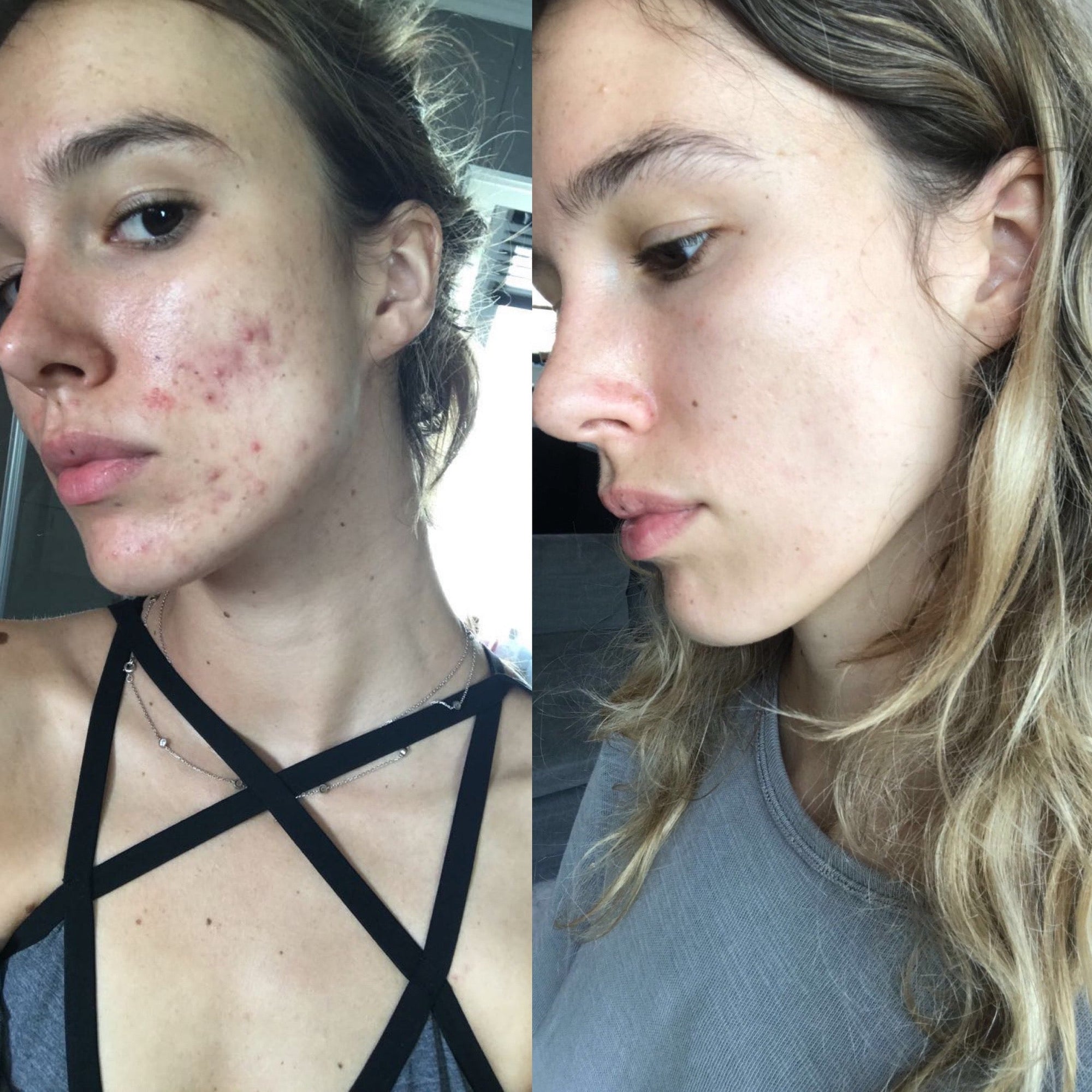How I cleared my acne Monday Muse(01)