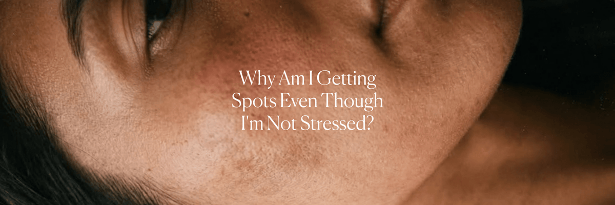 Why Am I Getting Spots Even Though I'm Not Stressed? - Monday Muse
