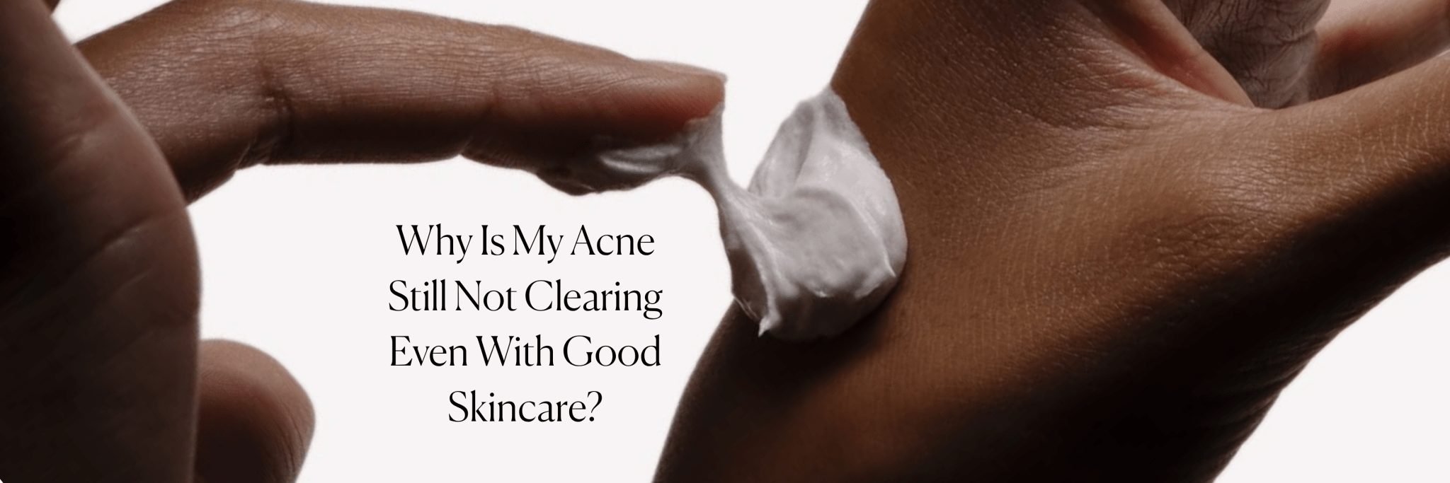 Why Is My Acne Still Not Clearing Even With Good Skincare? - Monday Muse