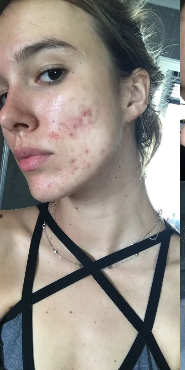 Lune before discovering her inside-out skincare method